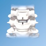 PRODISC-C in spine