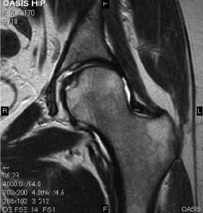 Hip joint MRI using Hitachi OASIS
