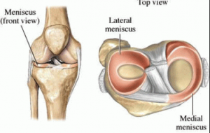 knee cartilage or meniscal tear anatomy diagram
