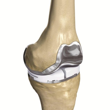 ConforMIS