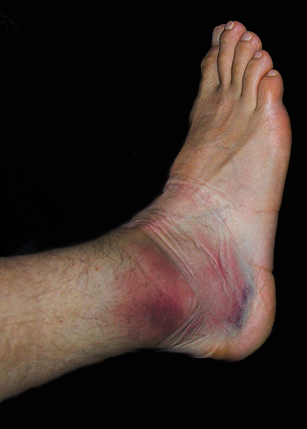 Ankle%20sprain