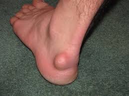image of Ganglion Cyst of the foot